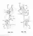 Fig. 19 - Adjustable brace assembly and methods of use