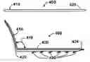 Fig. 01 - Apparatus and methods for correcting nasal valve collapse