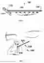 Fig. 02 - Apparatus and methods for correcting nasal valve collapse