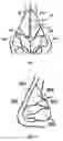 Fig. 05 - Apparatus and methods for correcting nasal valve collapse