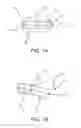 Fig. 02 - Mandibular advancement device