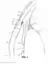 Fig. 02 - Intraocular implants and methods and kits therefor