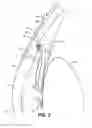 Fig. 03 - Intraocular implants and methods and kits therefor