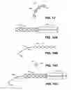 Fig. 16 - Intraocular implants and methods and kits therefor
