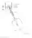 Fig. 33 - Suture sleeve patch and methods of delivery within an existing arthroscopic workflow