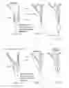 Fig. 34 - Suture sleeve patch and methods of delivery within an existing arthroscopic workflow