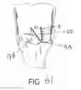 Fig. 41 - Suture sleeve patch and methods of delivery within an existing arthroscopic workflow