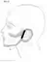 Fig. 10 - Facial structure stabilization methods and apparatus
