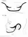 Fig. 13 - Facial structure stabilization methods and apparatus