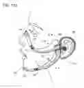 Fig. 18 - Facial structure stabilization methods and apparatus