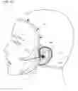 Fig. 21 - Facial structure stabilization methods and apparatus