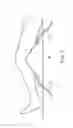 Fig. 08 - AID PAD OF EXTERNAL COMPRESSION TREATMENT COURSE