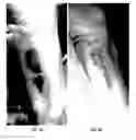 Fig. 04 - Method for treating deleterious effects arising from tattoos