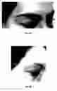 Fig. 06 - Method for treating deleterious effects arising from tattoos