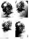 Fig. 10 - Method for treating deleterious effects arising from tattoos