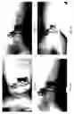 Fig. 14 - Method for treating deleterious effects arising from tattoos