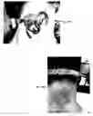 Fig. 16 - Method for treating deleterious effects arising from tattoos