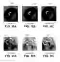 Fig. 10 - Shape changing drug delivery devices and methods