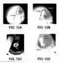 Fig. 11 - Shape changing drug delivery devices and methods
