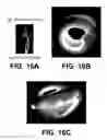 Fig. 15 - Shape changing drug delivery devices and methods