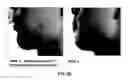 Fig. 10 - COMPOSITION CONTAINING PSEUDOMONAS AERUGINOSA CULTURE SOLUTION EXTRACT HAVING ANTIBIOTIC AND ANTISEPTIC ACTIVITIES, AND USE THEREOF