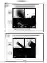 Fig. 25 - Coated surgical mesh, and corresponding systems and methods