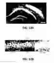 Fig. 13 - Systems and methods for treating dementia