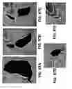 Fig. 88 - Systems and methods for treating dementia