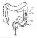 Fig. 01 - DEVICES, SYSTEMS AND METHODS FOR TREATING ULCERATIVE COLITIS AND OTHER INFLAMMATORY BOWEL DISEASES