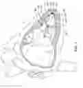 Fig. 02 - Delivery devices and methods for leadless cardiac devices