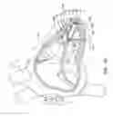 Fig. 13 - Delivery devices and methods for leadless cardiac devices