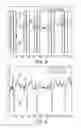 Fig. 05 - Determining onsets and offsets of cardiac depolarization and repolarization waves