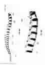 Fig. 52 - Leadless neurostimulator