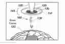 Fig. 01 - LASER-ASSISTED DRUG DELIVERY SYSTEM