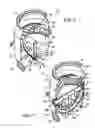 Fig. 05 - Debris filter with filter screen in the form of a spherical section