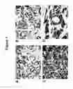 Fig. 02 - B7-H3 IN CANCER