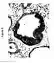 Fig. 03 - B7-H3 IN CANCER