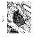 Fig. 04 - B7-H3 IN CANCER