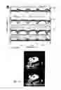 Fig. 04 - Dynamic contrast enhanced magnetic resonance imaging with flow encoding