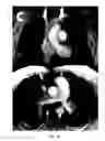 Fig. 07 - Dynamic contrast enhanced magnetic resonance imaging with flow encoding