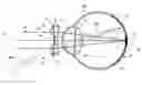Fig. 01 - Myopia control means