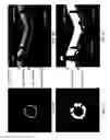 Fig. 05 - Detection of and validation of shadows in intravascular images