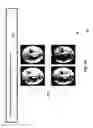 Fig. 75 - Neuroplasticity games for depression
