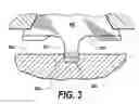 Fig. 04 - SOLDERED INTERCONNECT FOR A PRINTED CIRCUIT BOARD HAVING AN ANGULAR RADIAL FEATURE