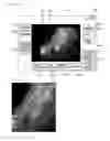 Fig. 05 - METHOD FOR MEASURING SIZE OF LESION WHICH IS SHOWN BY ENDOSCOPE, AND COMPUTER READABLE RECORDING MEDIUM