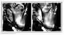 Fig. 01 - Mapping and quantifying blood stasis and thrombus risk in the heart