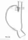 Fig. 24 - Methods and devices for manipulating and fastening tissue