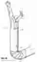 Fig. 28 - Endoscopic stitching devices