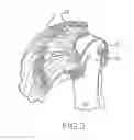 Fig. 03 - Suture sleeve patch and methods of delivery within an existing arthroscopic workflow