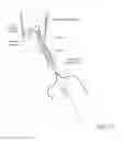 Fig. 31 - Suture sleeve patch and methods of delivery within an existing arthroscopic workflow